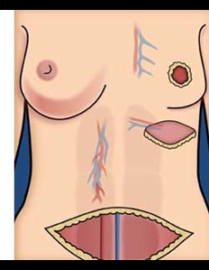 Breast